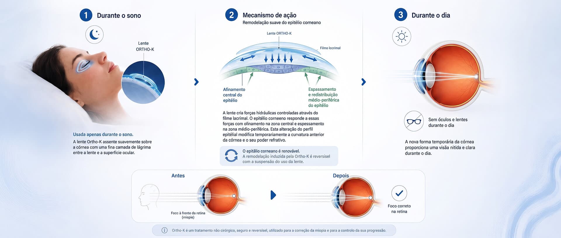 Como funciona a Ortho-K: durante o sono a lente remodela suavemente a córnea; durante o dia, visão nítida sem óculos